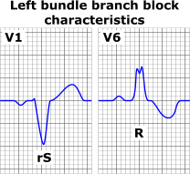 left bundle branch block
The QRS duration must be ≥ 120 ms[2]
There should be a QS or rS complex in lead V1
There should be a RsR' wave in lead V6.