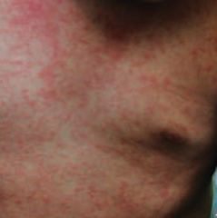 Roseola
- High fevers for several days
- Can cause seizures
- Diffuse macular rash (picture)