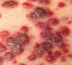 Kaposi Sarcoma
- Neoplasm of endothelial cells
- Seen in HIV/AIDS and transplant patients
- Dark / violaceous flat and nodular skin lesions (picture) representing endothelial growths
- Can also affect GI tract and lungs