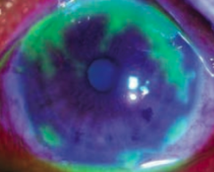 Keratoconjunctivitis (inflammation of cornea and conjunctiva)
- Sign of HSV-1 infection