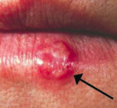 Herpes Labialis
- Sign of HSV-1 infection
