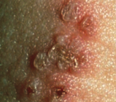 Herpes genitalis
- Sign of HSV-2 infection