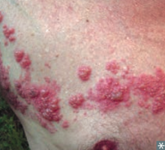 Shingles (VZV was latent in dorsal root)
- Sign of VZV / HHV-3 infection