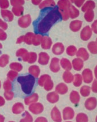 Atypical lymphocytes are reactive cytotoxic T cells
- Sign of EBV / mononucleosis
- Confirm with Monospot test (heterophile antibodies detected by agglutination of sheep or horse RBCs)