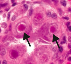 "Owl eye" inclusions
- Infected mononuclear cells with CMV / HHV-5
- Can cause mononucleosis but would have negative monospot test