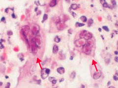 - Viral culture for skin / genitalia
- CSF PCR for herpes encephalitis
- Tzanck test (genital herpes) - a smear of an opened skin vesicle to detect multinucleated giant cells (picture)
- Infected cells also have intranuclear Cowdry A inclusions