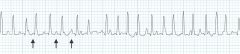 P waves of different morphology and tachycardia, variable RR and PR segments. Think? Caused by?