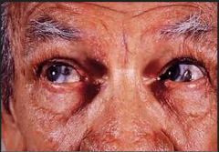 pigmented sclera and skin because of buildup of homogenistic acid