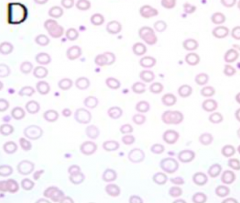 Elevated RDW
- This is increased because there is a lot of variation in size and shape

a) Would not expect a high reticulocyte count
b) Would expect a low MCH
d&e) Would expect normal RBC count