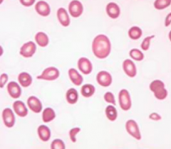 Megaloblastic Anemia (tear shaped cells, big cells)