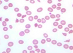 Fragmentation / Schistocytes