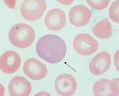 Reticulocyte / polychromasia:
- Abnormally high number of red blood cells found in the bloodstream as a result of being prematurely released from the bone marrow during blood formation