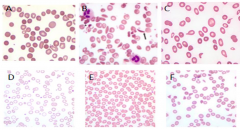 E (normal blood smear)

80% of Anemia of Chronic Disease have normocytic, normochromic presentations. Lesser number have microcytic, hypochromic anemia.