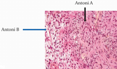 schwannoma has two vriations