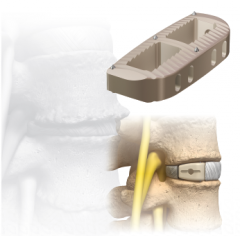 CoRoent XL-W.
Implante intersomàtico de fusiòn lumbar.