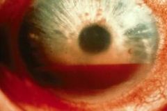Patch eye sit upright.

Blood anterior chamber