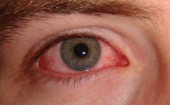 woke up with eye glued shut, injected, watery or prurulent discharge. Occuflox. throw out contacts until finished