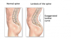Lordosis is an exaggerated posterior curvature of the spine commonly found in the lumbar region. Common causes are pregnancy and obesity which overcome and can sprain the anti-gravity muscles of the lower back.