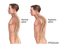An exaggerated anterior curvature of the spine commonly found in the thoracic region. This hunchback is seen in elderly post-menopausal women due to a loss of estrogen bone mass decreases and compression fractures in the vertebrae leading to this ...