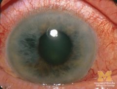 Acute Angle Glaucoma