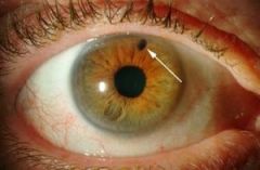 older pt hx of glaucona, goes into dark area and sudden pain. Iris bulge blocks vitreous humor flow from posterior to ant chamber. Cloudy cornea. Timolol, pilocarpine

Image is laser iridotomy, hole made to drain iris. colored part of eye