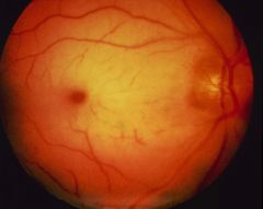 sudden painless loss of vision in pt with afib. cherry red spot on macula, Fundoscopic exam
Massage eye to disloge clot, timolol, pilocarpine

1st image retinal vein occlusion. Engored, dilated veins on fundoscope.

2nd image retinal artery o...