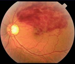 central retinal vein occlusion

central retinal artery occlusion