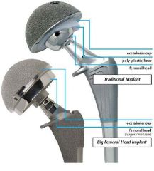 Smaller implant diameter is associated with elevated serum metal ion levels with metal-on-metal hip resurfacing arthroplasty. 

Metal-on-metal (MOM) hip resurfacing arthroplasty has the advantage of better wear properties (lower linear wear rate...