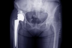 Which of the following variables is associated w elevated serum metal ion levels following metal-on-metal hip resurfacing arthroplasty?  1-Smaller implant diameter; 2-Smaller acetabular cup abduction angle; 3-Higher postop functional scores 
4-Se...