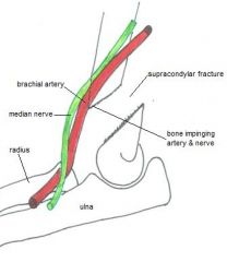 Brachial artery
(which would result in loss of radial pulse, so check it!