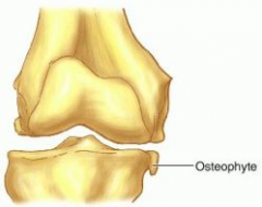 A reactive hypertrophic boney changes-a product of osteoarthritis