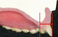 maxillary central incisors