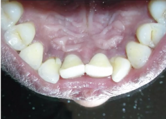 maxillary lateral incisors