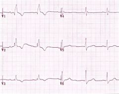 QRS>.12
RSR' in precordial leads V1,V2,V3 with reciprocal ST depression and t wave inversion