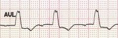 Notched R Waves in Lateral Leads and Typical Deep rS complex in precordial leads