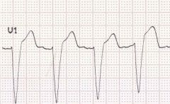 rS in precordial leads and wide QRS signifying LBBB with expected ST elevattion