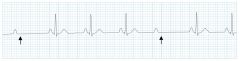 Normal PR interval, randomly dropped QRS/non-conducted P wave