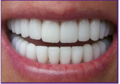 mandibular central incisors AND maxillary third molars