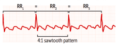 sawtooth pattern
back to back atrial depol waves

