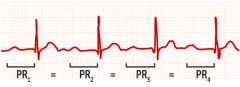 prolonged PR interval, >200msec


benign and asymp
no treatment required