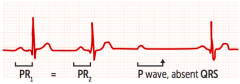 second degree heart block
dropped beats not preceded by a change in length of PR interval, get absent QRS all of a sudden post p wave
usu treated with pacemaker
risk of progression to 3rd degree heart block