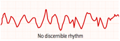 a completely erratic rhythm with no identifiable waves; fatal arrhythmia without immediate CPR and defibrillation