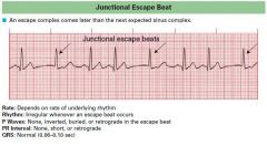 in cases of complete heart block where there is sinus node activity but failure of conduction of AV node or due to sinus bradycardia
AV node takes over as pacemaker
relatively slow rate


get narrow QRS complexes
can get inverted p waves and can b...