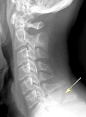 What type of fracture does this radiograph show?