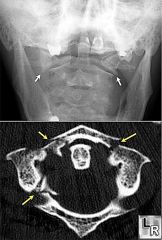 What type of fracture do these radiographs show?