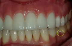 between mandibular 2nd premolar and 1st molar