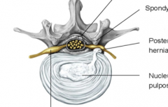 The nucleus pulposus of intervertebral discs.
