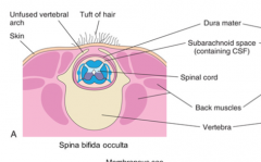 10% of the population has this asymptomatic type of spina bifida where the vertebral arch is not completely formed sometimes recognized by a tuft of hair or dimple in the lower back?
Occulta = hidden