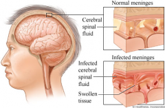 An inflammation of the meninges which can lead to a severe headache, stiff neck "nuchal rigidity", and photophobia