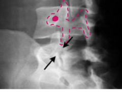 A fracture of the pars interarticularis as seen from an oblique x-ray in which the "dog" drawn from the superior to the inferior facet and transverse process (eye) has a fracture around its neck.